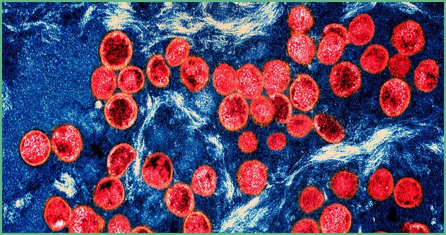 Monkeypox Severe Strain Detected In Los Angeles Officials Confirm