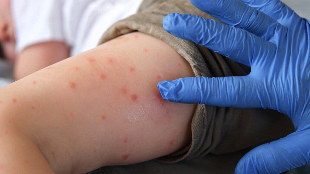 Pennsylvania Measles Deaths, First In 35 Years Spark Vaccine Push